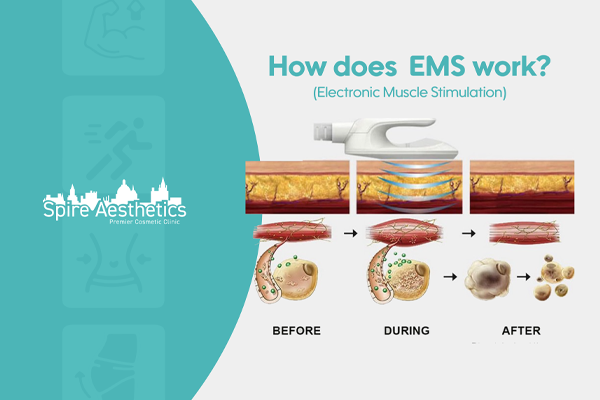 EMS treatment for post pregnancy weight loss treatment East Kilbride