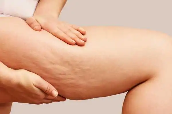 Image of woman showing leg with cellulite East Kilbride