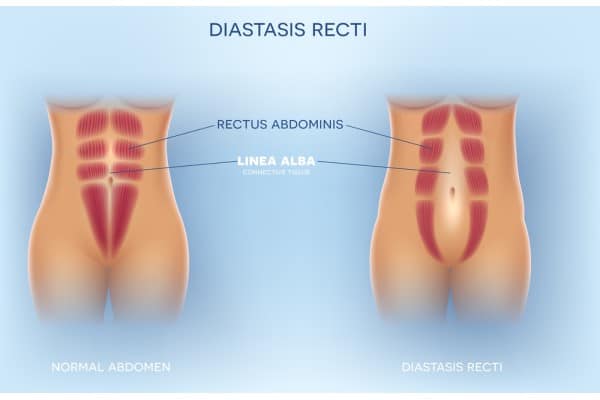What Non-Surgical Options Are Available for Diastasis Recti East Kilbride?