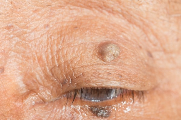 Skin imperfections East Kilbride - Cryopen is fast and effective book in today!