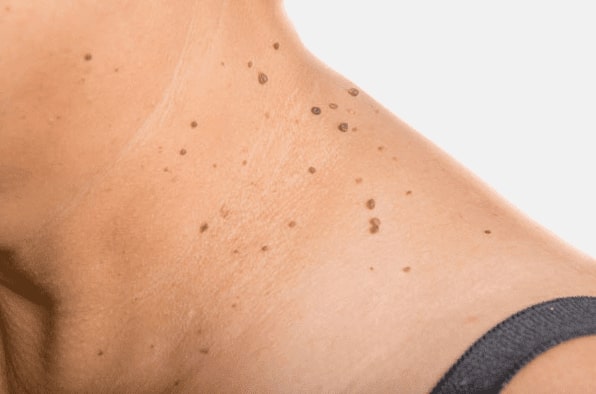 Are you looking for easy skin tag removal East Kilbride - then contact Spire today!