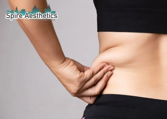 Image of woman pinching fat on their hips East Kilbride. Fat Freezing treatment 