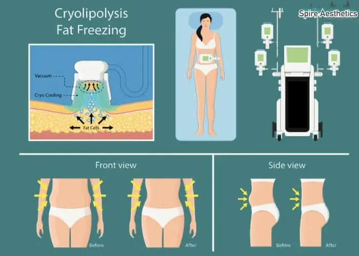 Fat freezing treatment East Kilbride benefits for competitions to remove stubborn fat deposits.