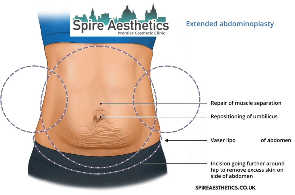 Understanding Loose Skin After Gastric Band East Kilbride Surgery and HIFU Treatment 