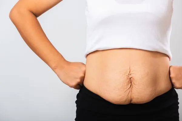 Image of a woman's stomach after weight loss with sagging skin following a gastric band East Kilbride