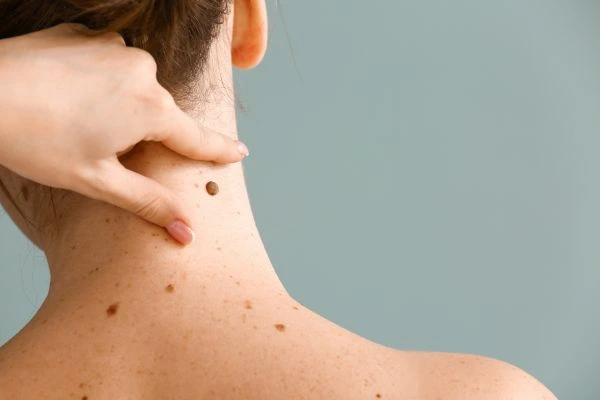 Prices and promotions for blemish removal East Kilbride contact our team today!