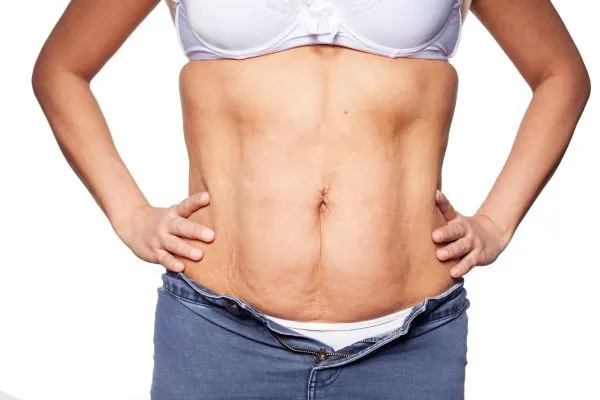 sagging skin on woman's stomach after weight loss injections East Kilbride
