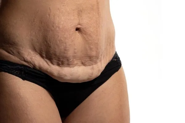 Image of womans stomach after weight loss injections East Kilbride showing saggy skin