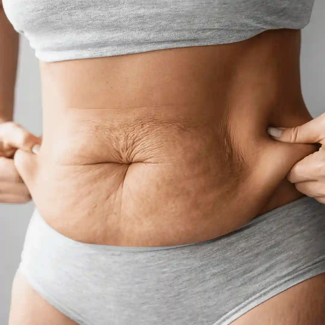 Is It Normal to Have Loose Skin After Pregnancy East Kilbride?