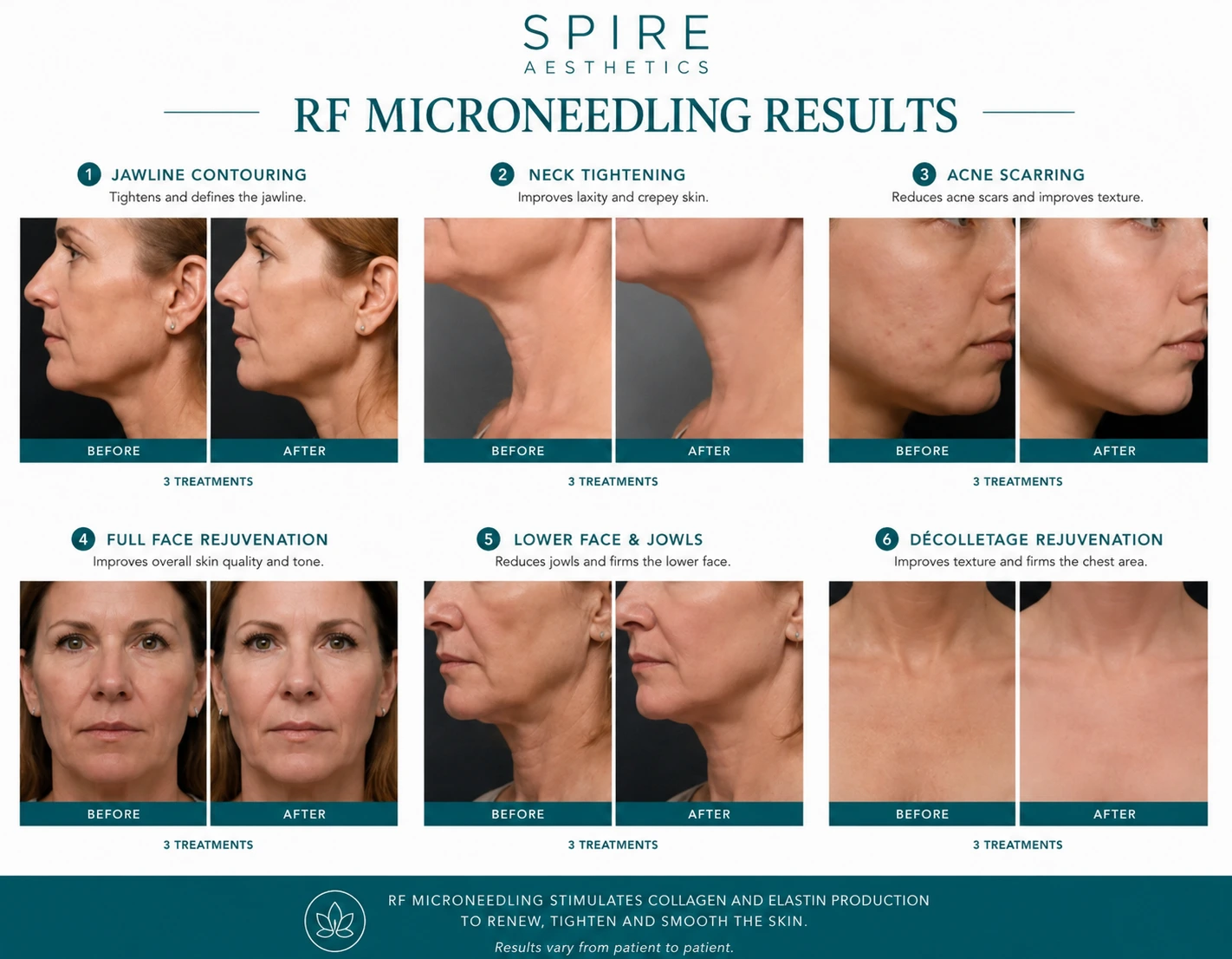 RF Microneedling Skin tightening East Kilbride results