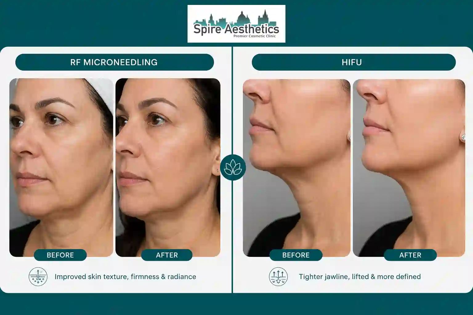 Can RF Microneedling and HIFU Be Combined East Kilbride?
