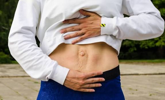 When Could Diastasis Recti Be the Missing Piece of the Puzzle East Kilbride?