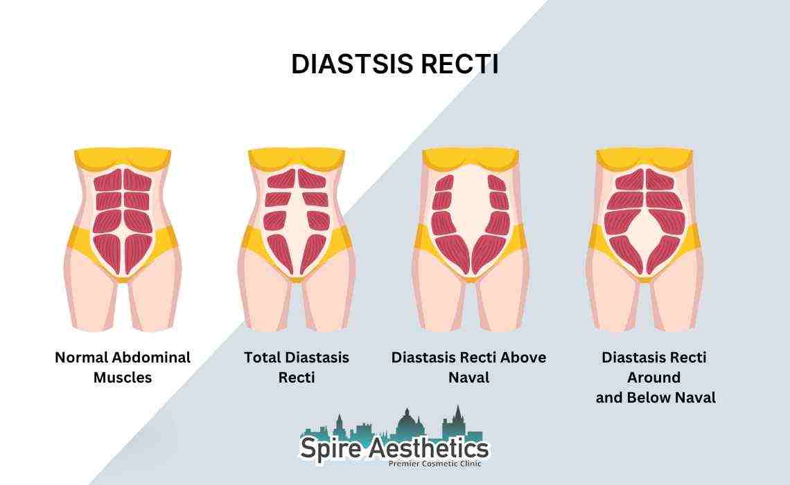 Is Non-Surgical Diastasis Recti Treatment Right for You? Common Concerns Answered East Kilbride